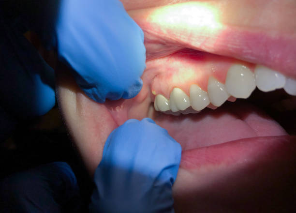 Best Emergency Denture Repair in Gloster, MS